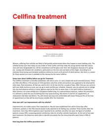 Cellfina treatment