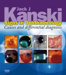 Signs in Ophthalmology: Causes and Differential Diagnosis E-Book