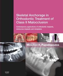 Skeletal Anchorage in Orthodontic Treatment of Class II Malocclusion E-Book