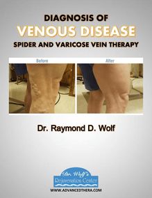 Diagnosis of Venous Disease (Spider and Varicose Vein Therapy) - Dr Raymond D Wolf