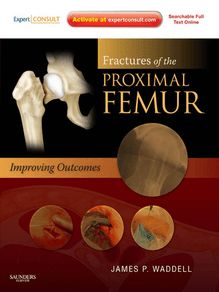 Fractures of the Proximal Femur: Improving Outcomes E-Book