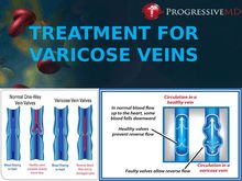 Treatment for Varicose Veins In Los Angeles CA