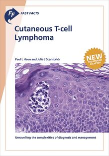 Fast Facts: Cutaneous T-cell Lymphoma