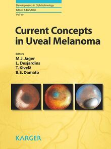 Current Concepts in Uveal Melanoma